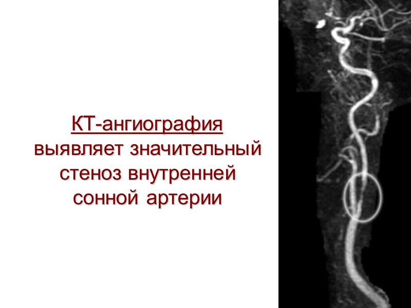 КТ-ангиография выявляет значительный стеноз внутренней сонной артерии